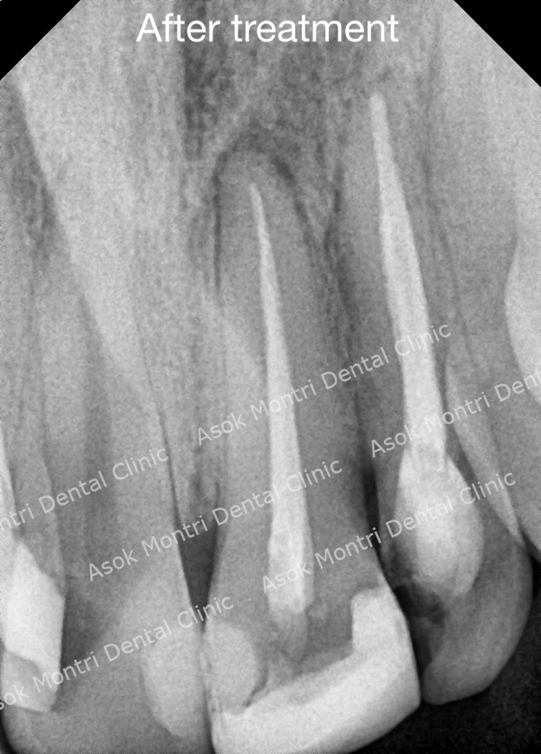 Root Canal After Treatment