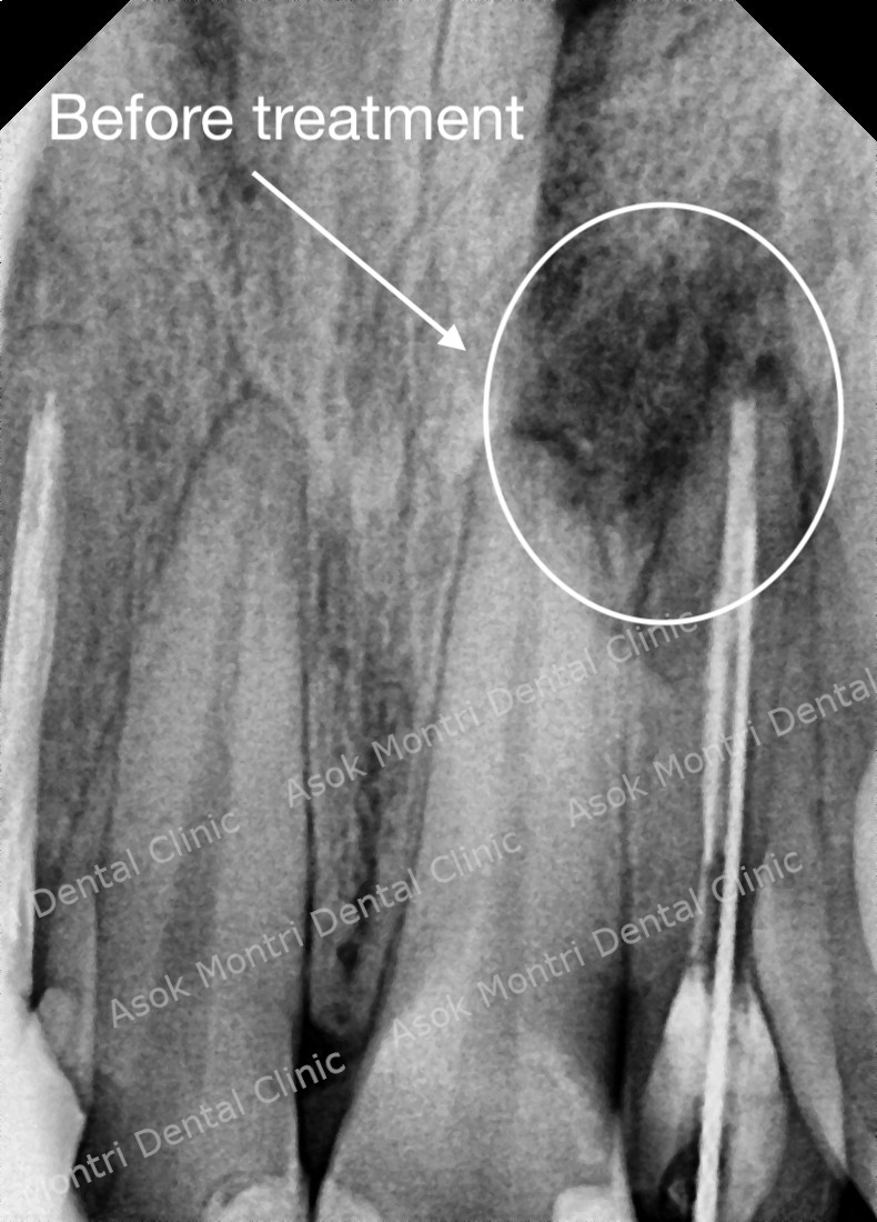 Root Canal Before Treatment